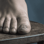 ongle pied qui pourrit vue macro